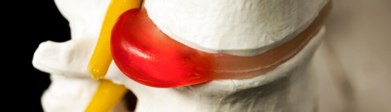 Scopri di più sull'articolo Ernia del disco ad Arce | A-Medical